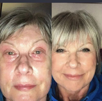 Andrea L. · Allergic Reaction