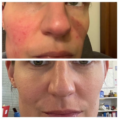 Jo M. · Rosacea