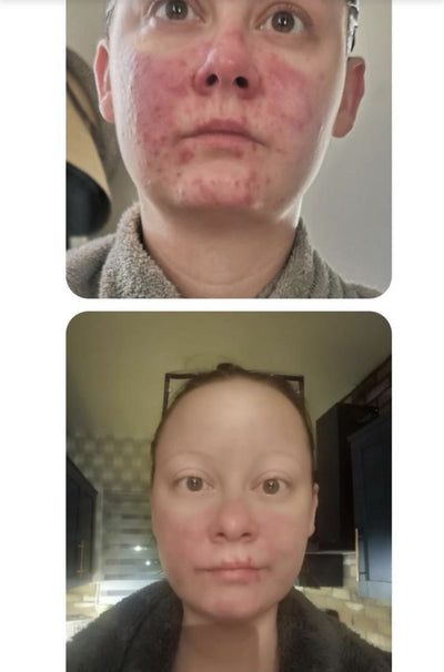 Kirsty · Rosacea