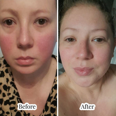 Alison F. · Rosacea