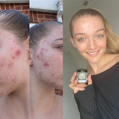 Ruby · Acne