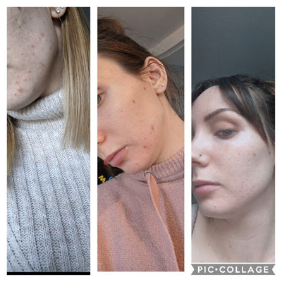Charlotte P. · Acne