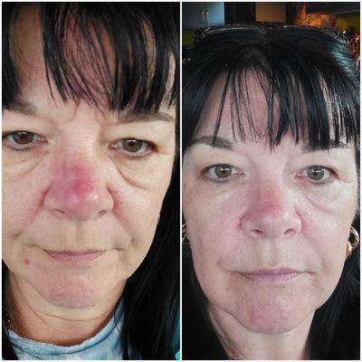 Val · Rosacea